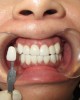 SmileMe 全瓷牙貼 (6隻牙)
